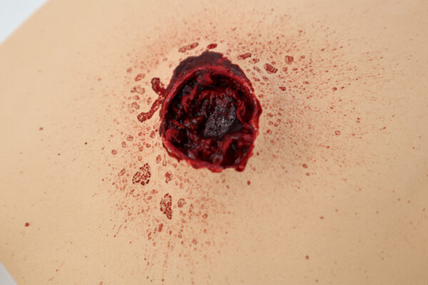 Bullet wound