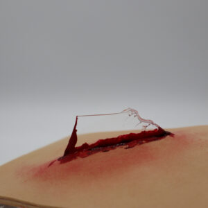 glass shard wound